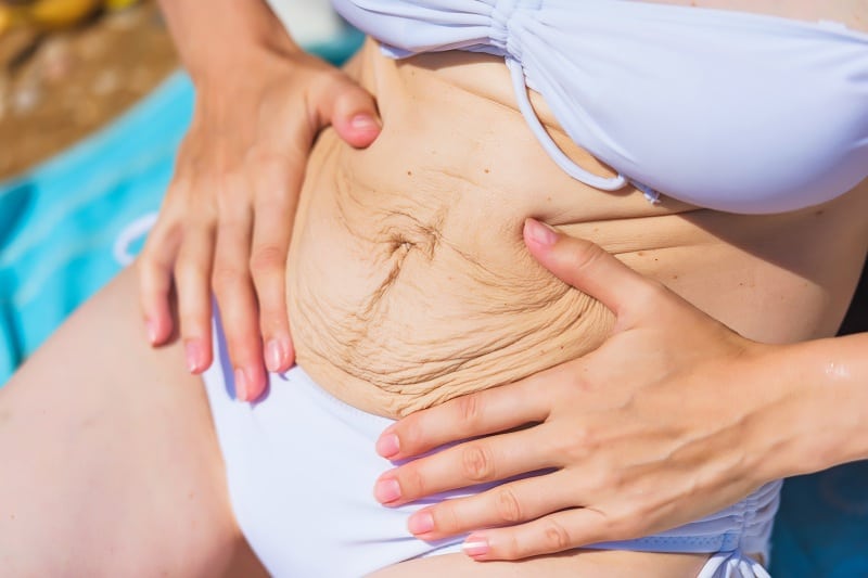 Belly skin after pregnancy